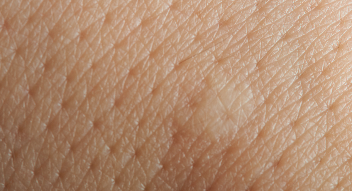 Enlarged pores