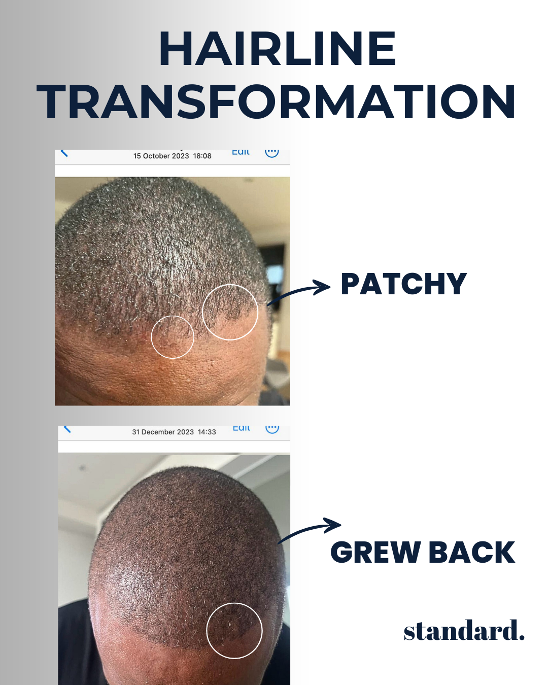 5-Months-Supply | Peptide Hair Growth Serum with Rosemary Extract & Plant-Stem-Cells