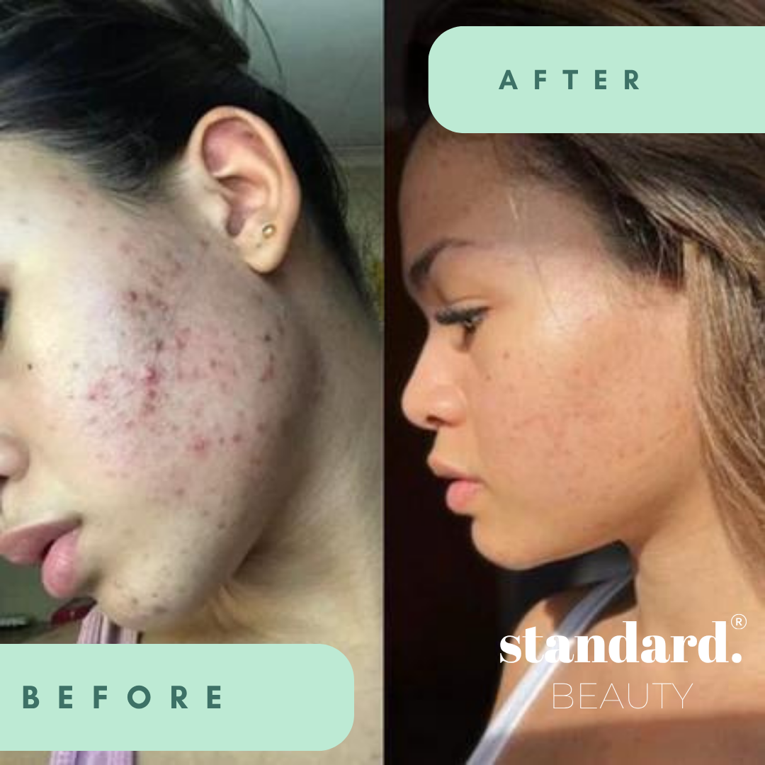 10% Niacinamide Serum with 1% Zinc & Hyaluronic Acid