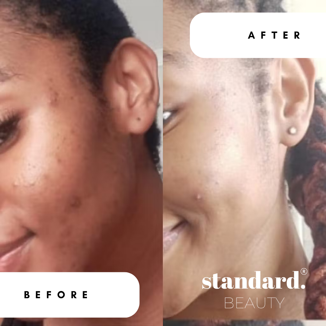 2% Alpha Arbutin Serum with 1% Hyaluronic Acid & Niacinamide