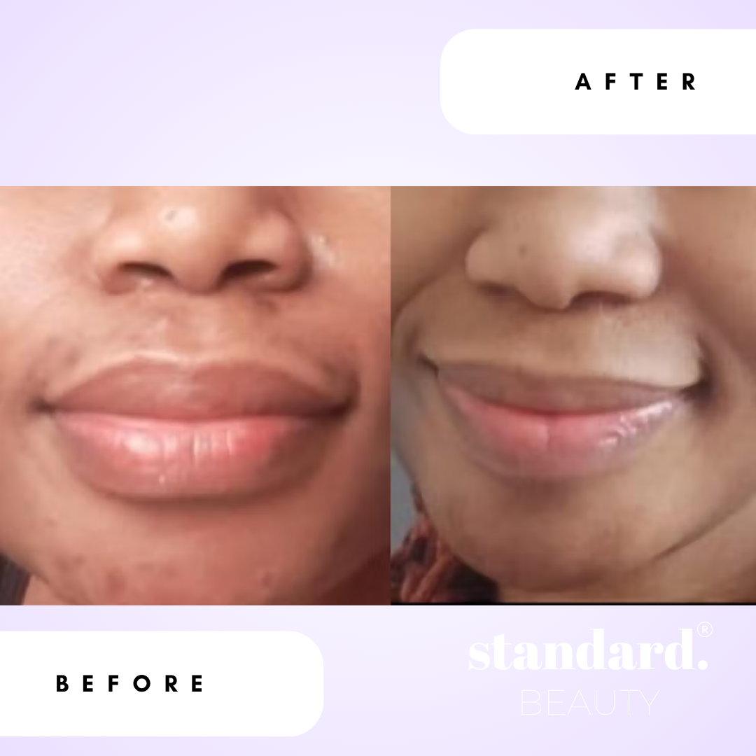 2% Alpha Arbutin Serum with 1% Hyaluronic Acid & Niacinamide