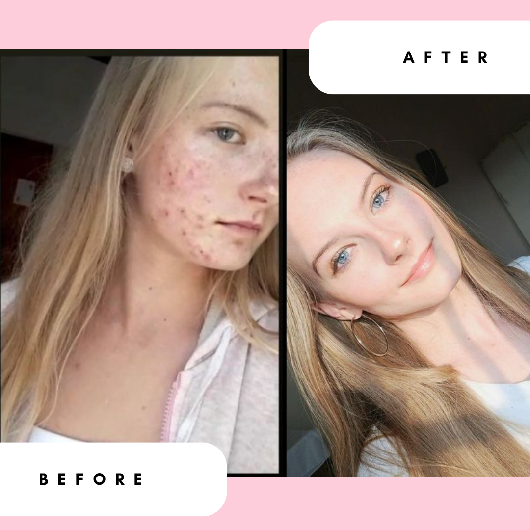 Mattifying Gel Moisturiser with 10% Azelaic Acid for Breakouts & Oily Skin