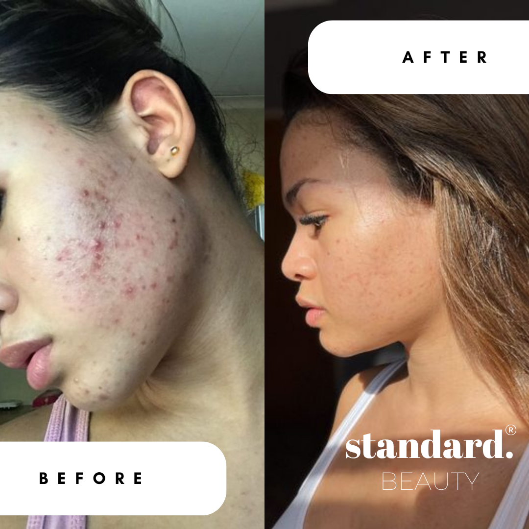 Retinyl Palmitate 1,5% (Vitamin A) Serum with Niacinamide & Hyaluronic Acid