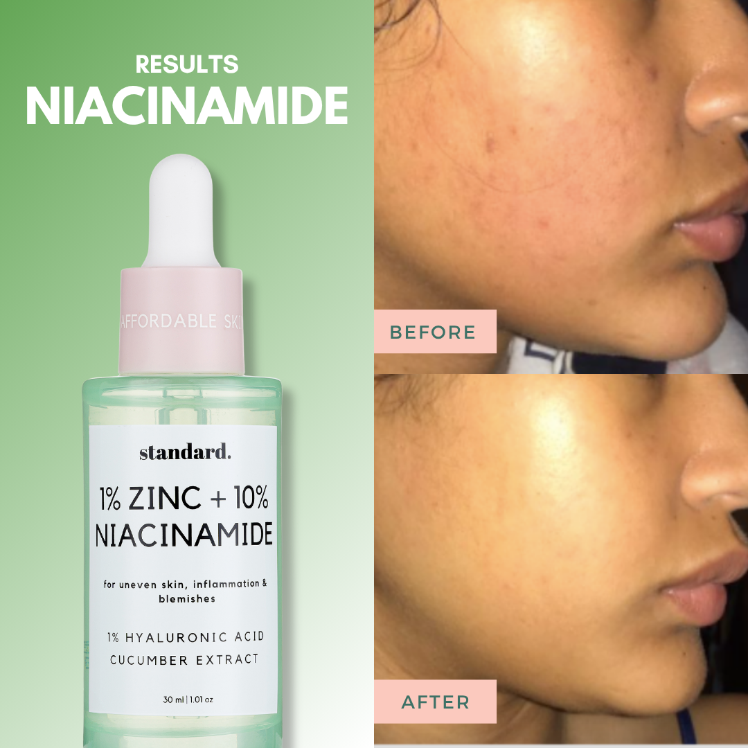 10% Niacinamide & 1% Zinc Serum with Hyaluronic Acid