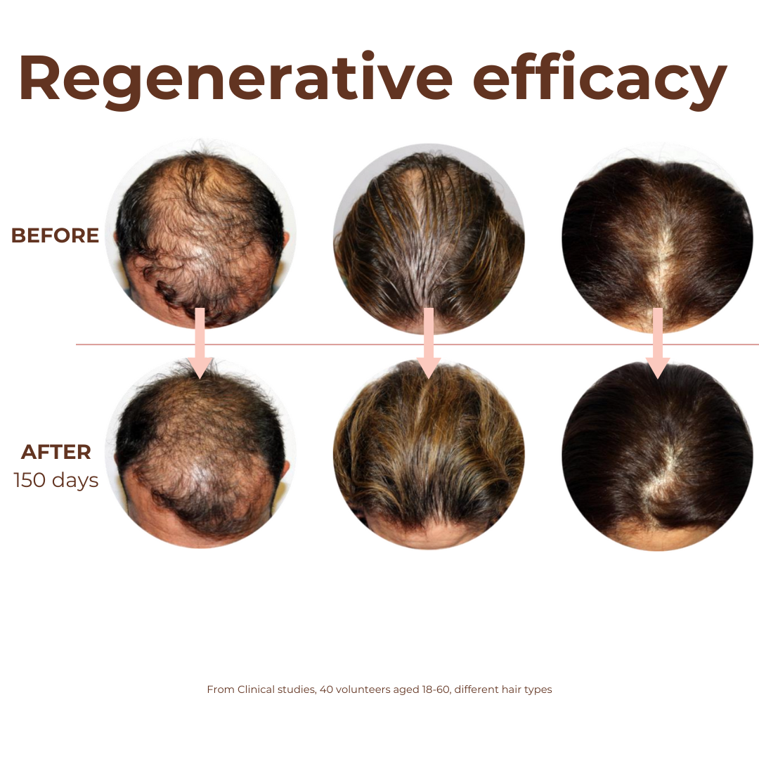 90 days Hair Growth Bundle: Hot Oil Hair Therapy with Rosemary Oil & Peptide Miracle Hair Growth Serum