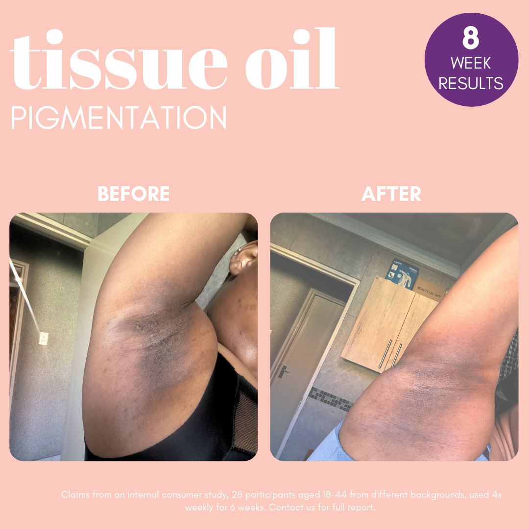Pigmentation Buster ™ Tissue Oil with Bright Oleoactif® & VF Lino®