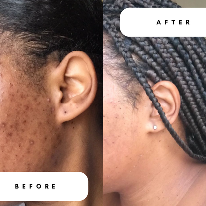 Salicylic Acid BHA 2% Toner for Breakouts &amp; Oily Skin