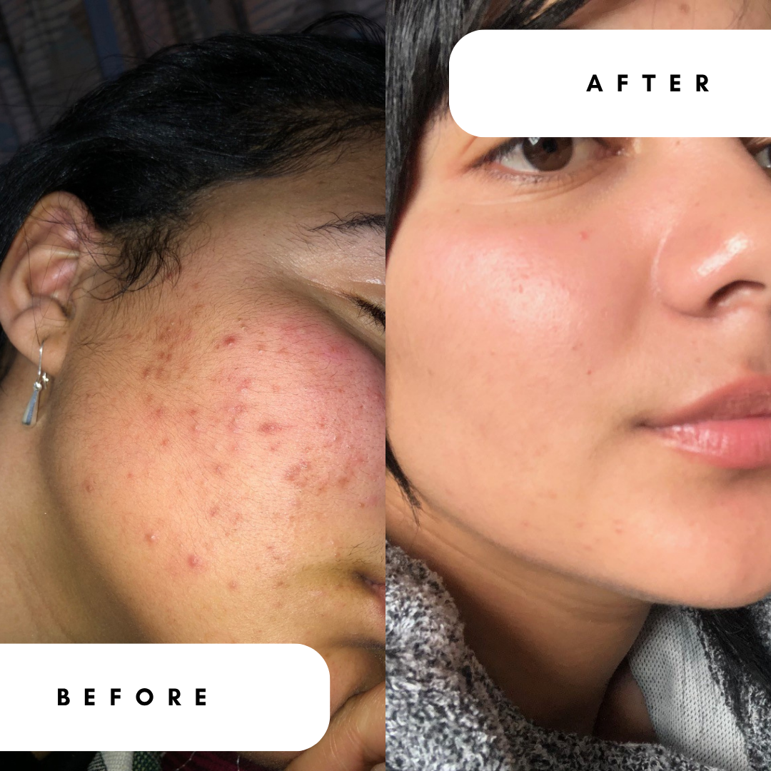 Salicylic Acid BHA 2% Toner for Breakouts &amp; Oily Skin