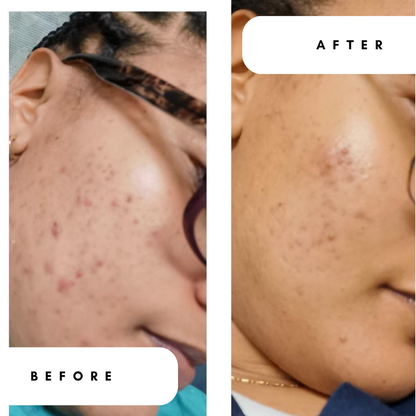 Mattifying Gel Moisturiser with 10% Azelaic Acid for Breakouts &amp; Oily Skin