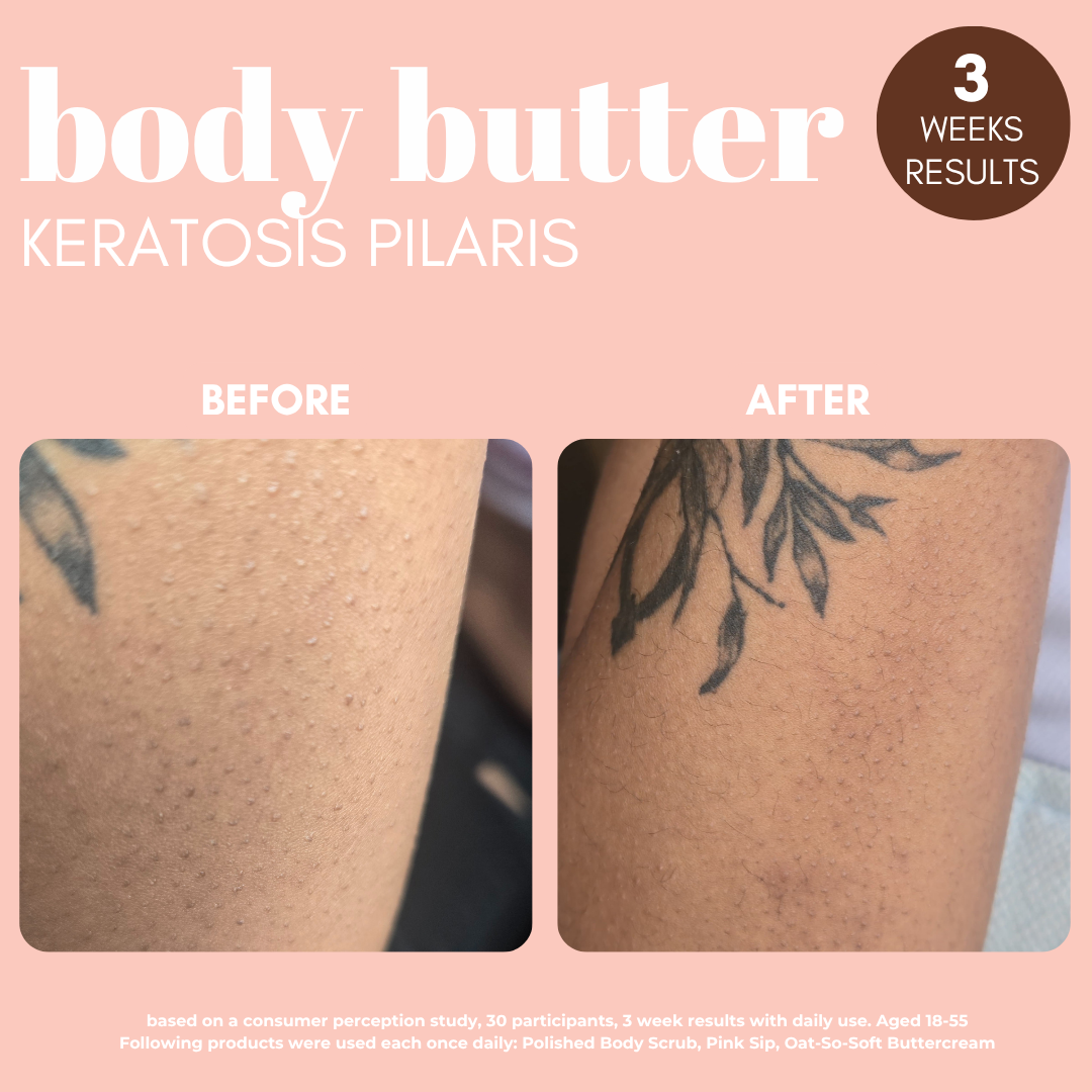 Oat-So-Soft Buttercream with Oat Extract &amp; 1% Salicylic Acid