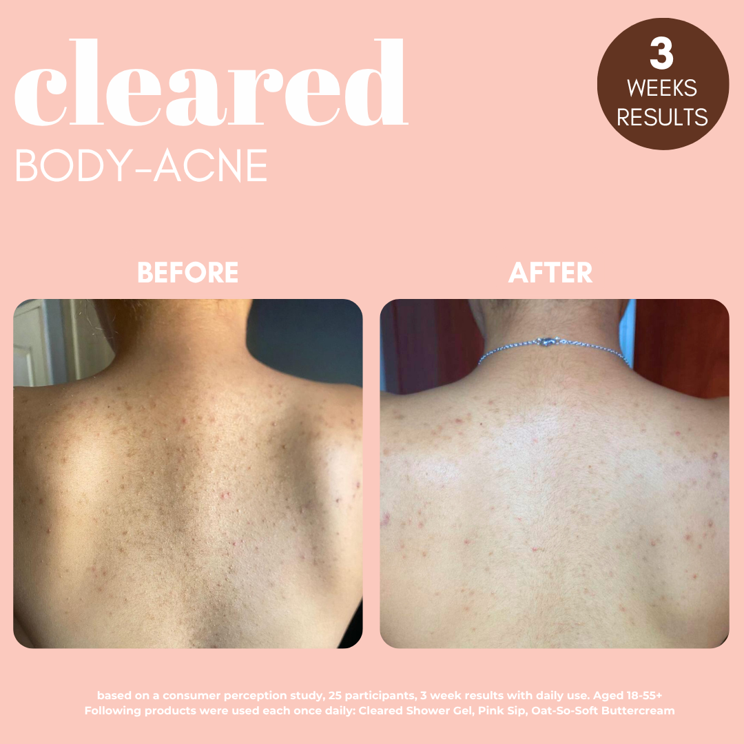 Cleared- 2% Salicylic Acid Body Wash for Body Breakouts