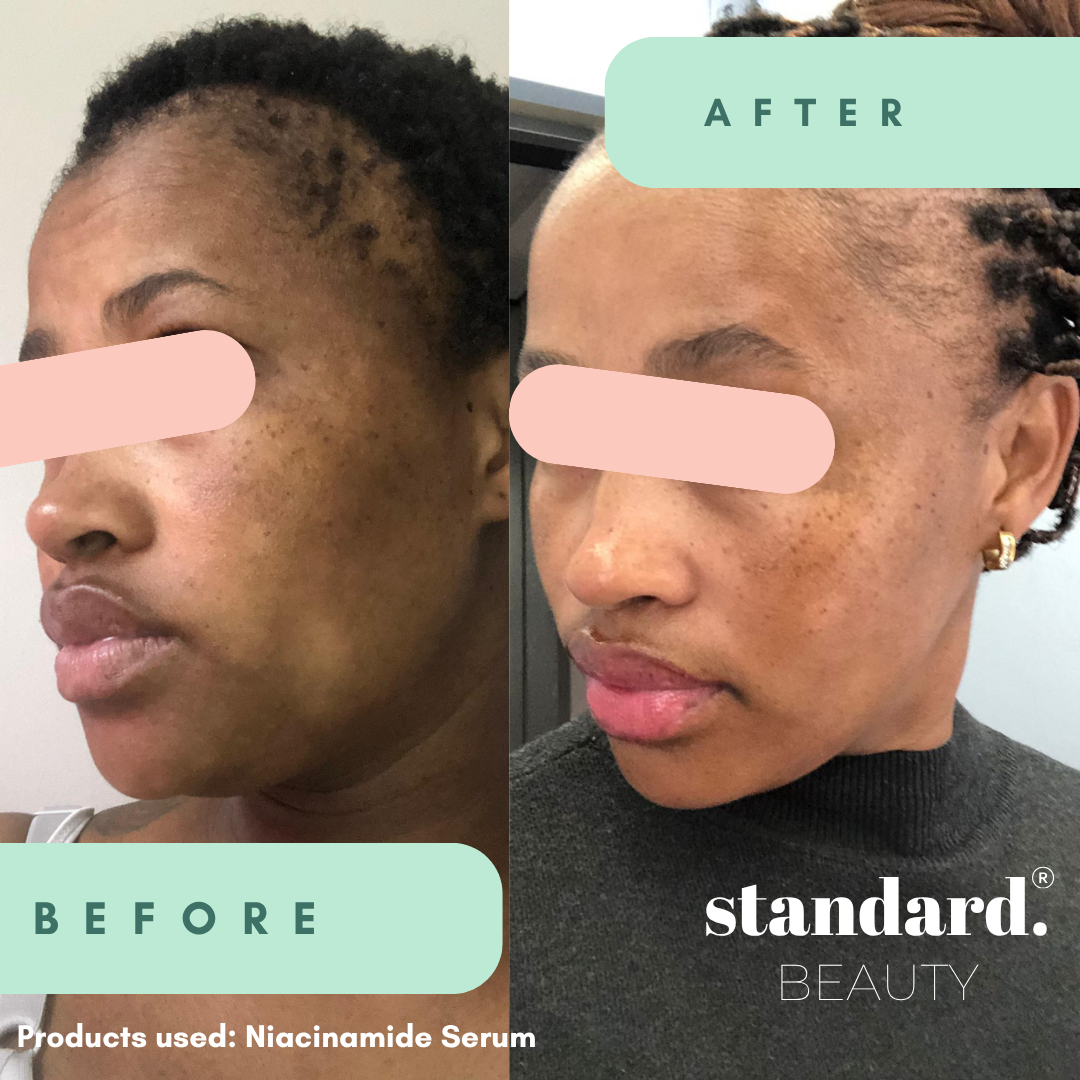 10% Niacinamide Serum with 1% Zinc &amp; Hyaluronic Acid