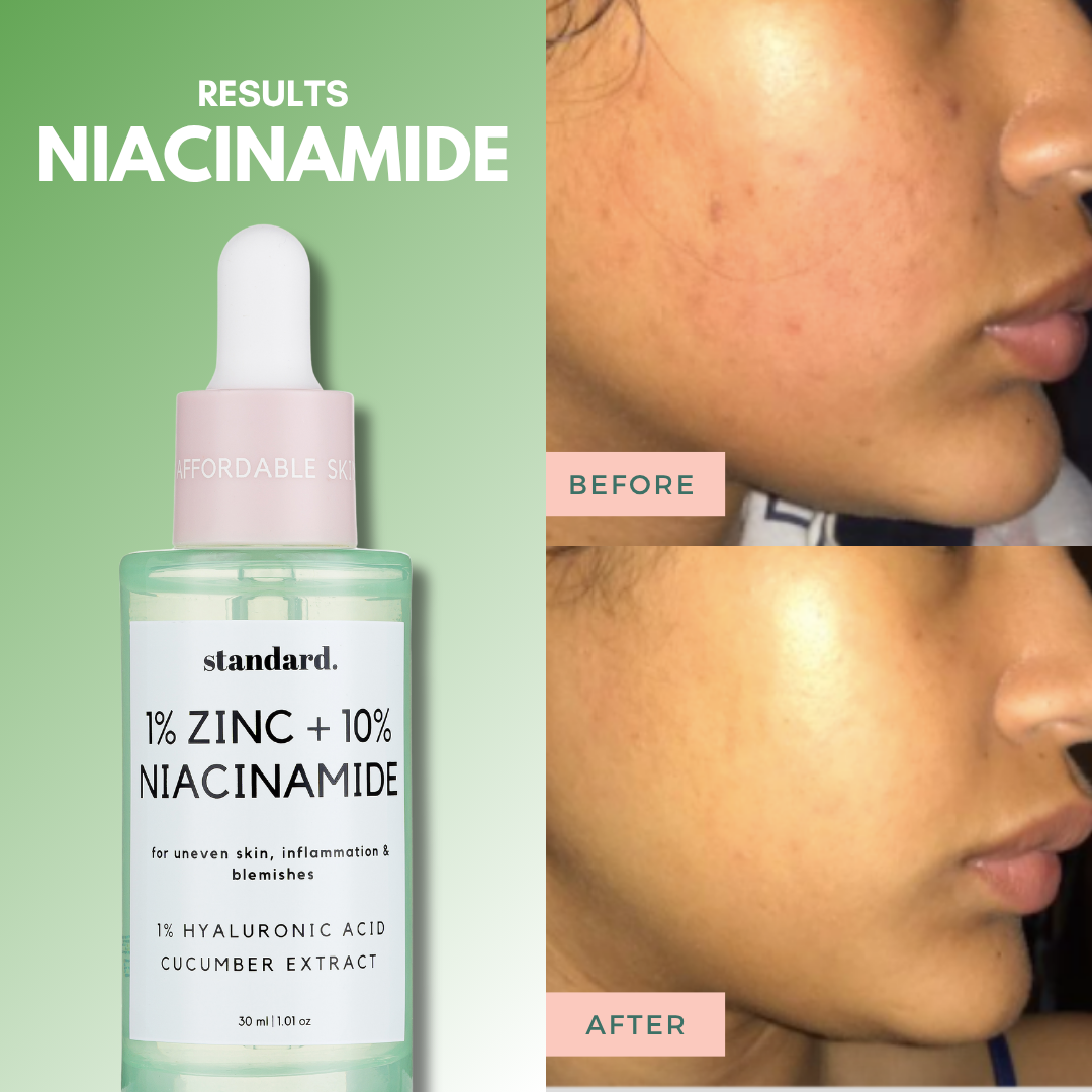 10% Niacinamide Serum with 1% Zinc &amp; Hyaluronic Acid