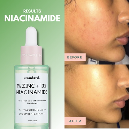 10% Niacinamide Serum with 1% Zinc &amp; Hyaluronic Acid