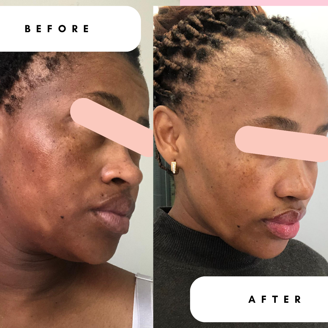 Mattifying Gel Moisturiser with 10% Azelaic Acid for Breakouts &amp; Oily Skin