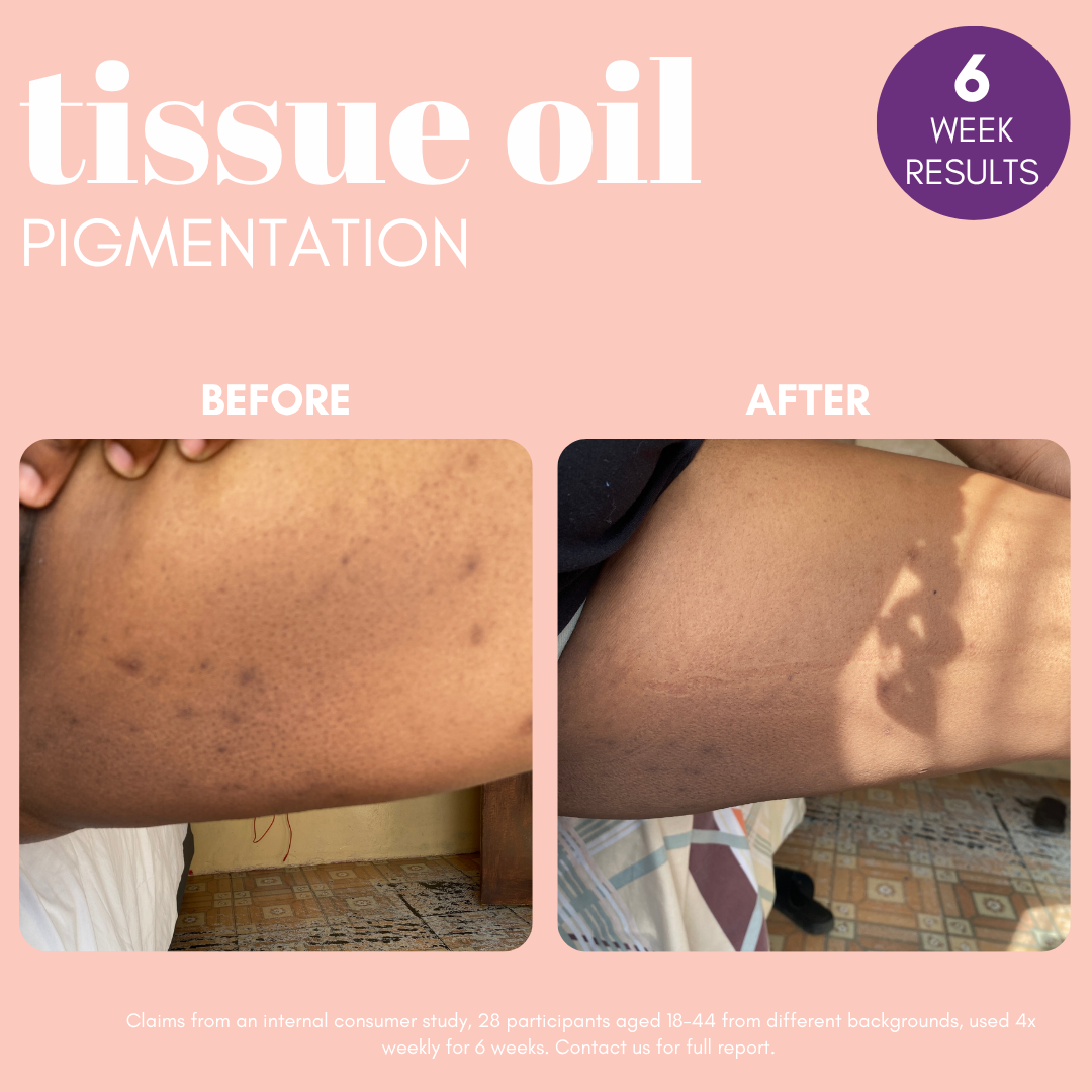 Pigmentation Buster ™ Tissue Oil with Bright Oleoactif® &amp; VF Lino®