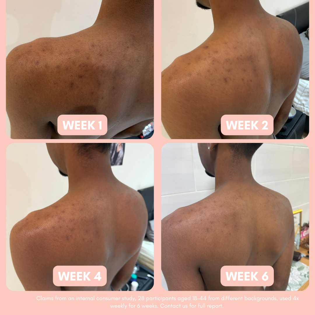 Pigmentation Buster ™ Tissue Oil with Bright Oleoactif® &amp; VF Lino®