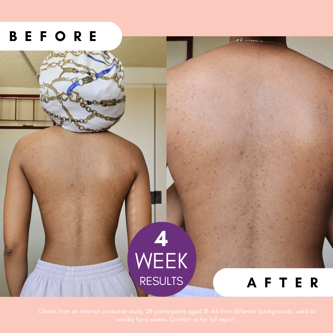 Pigmentation Buster ™ Tissue Oil with Bright Oleoactif® &amp; VF Lino®