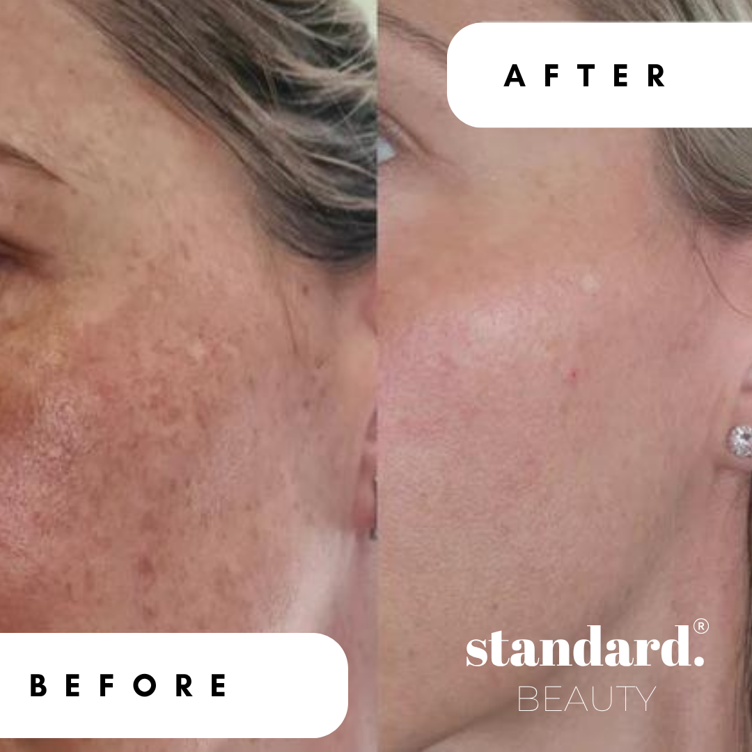 Brightening Vitamin C Serum in Polyglutamic Acid for Dark Marks &amp; Hydration